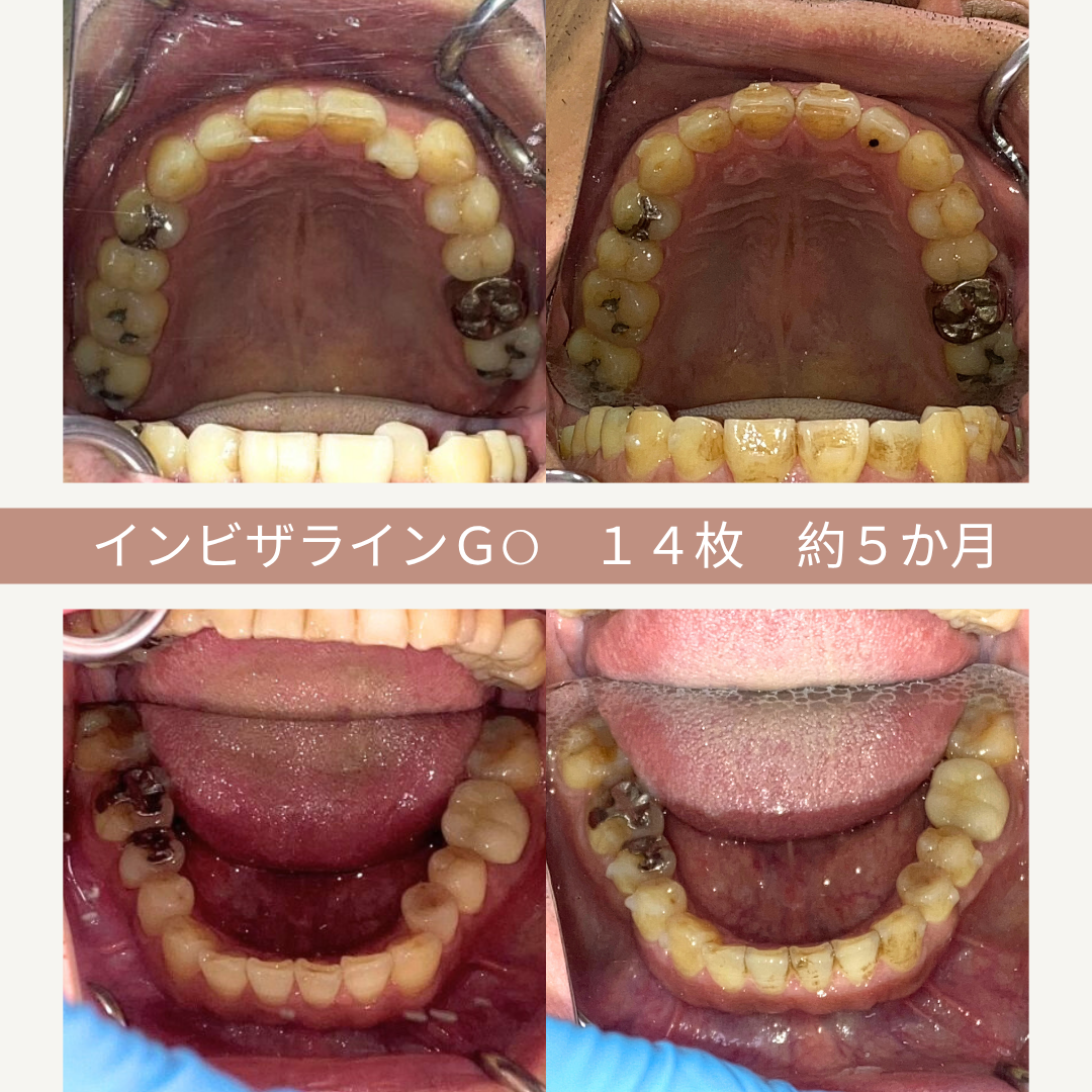 歯の矯正治療前後の口腔内写真。上段は歯列の写真、下段は舌と歯のアップ。文字で「インビザラインGO 14枚 約5か月」と記載されている。