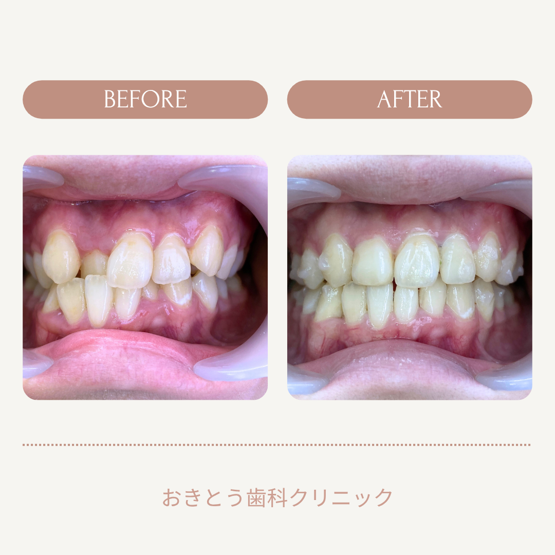 歯の矯正治療前と後の比較写真。左側がビフォーの歯並び、右側がアフターの歯並びを示す。