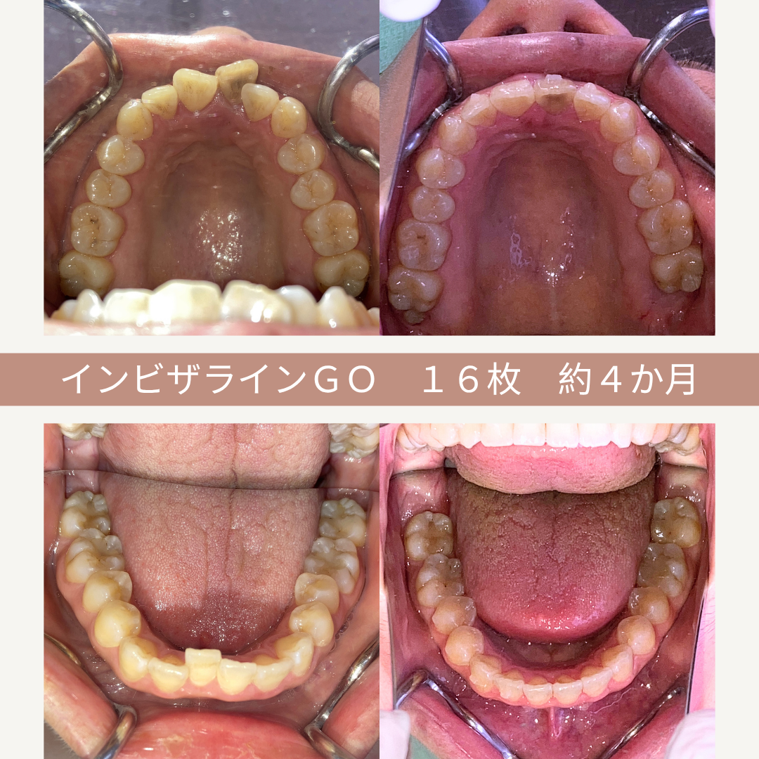上の二枚は歯の矯正治療後の歯並びの写真。下の二枚も同じく矯正治療後の歯の状態を示す写真。中央の文字は「インビザラインGO 16枚 約4か月」と記載されている。