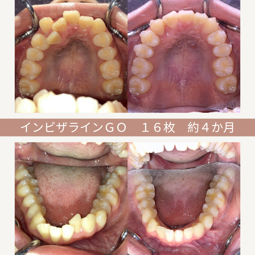 上下の歯のインビザライン矯正治療前後の比較写真。上段左は治療前の上顎、右は治療後。下段左は治療前の下顎、右は治療後。治療期間は約4か月で、16枚のマウスピースを使用したことがわかる。