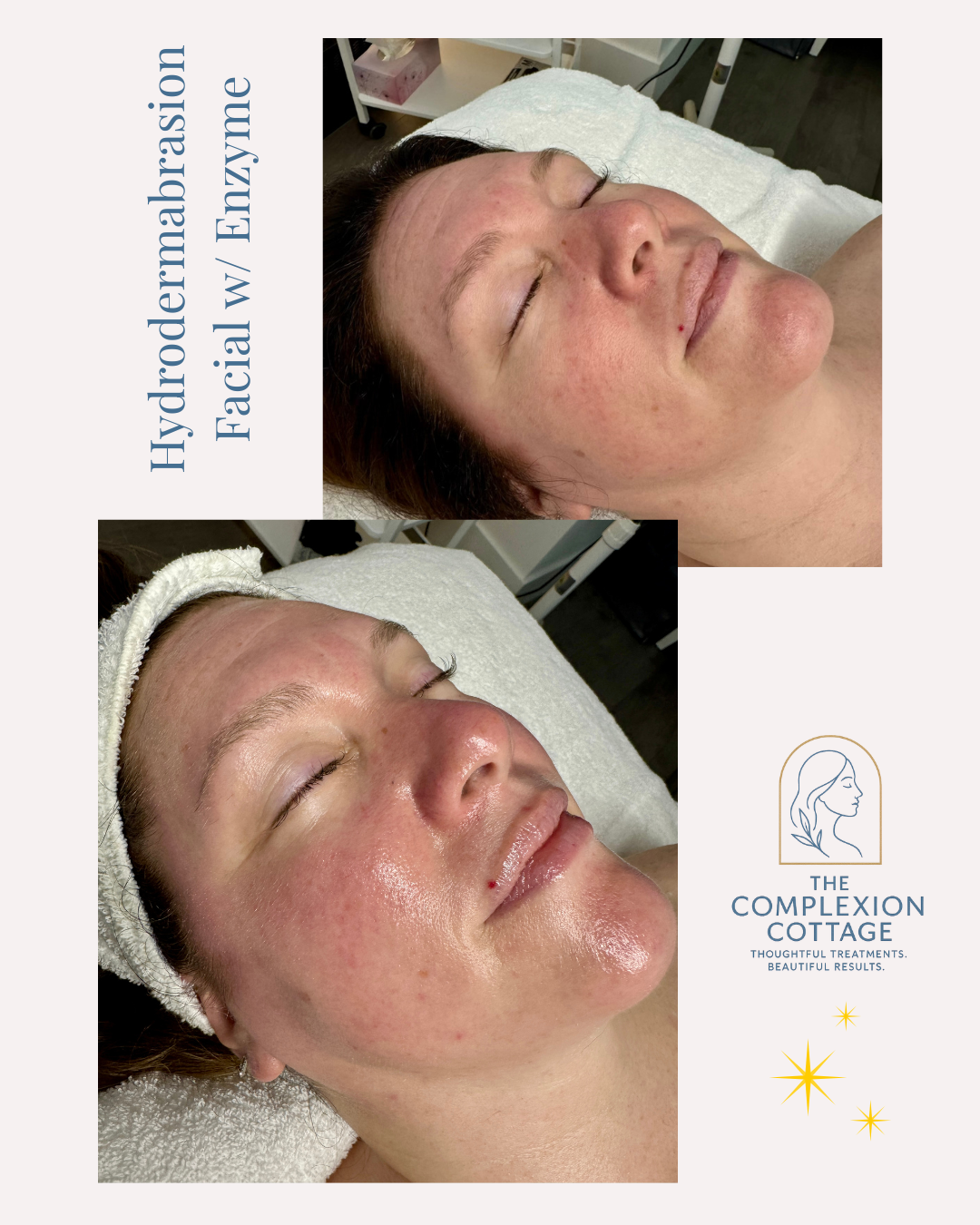 Hydrodermabrasion Facial w Enzyme.png
