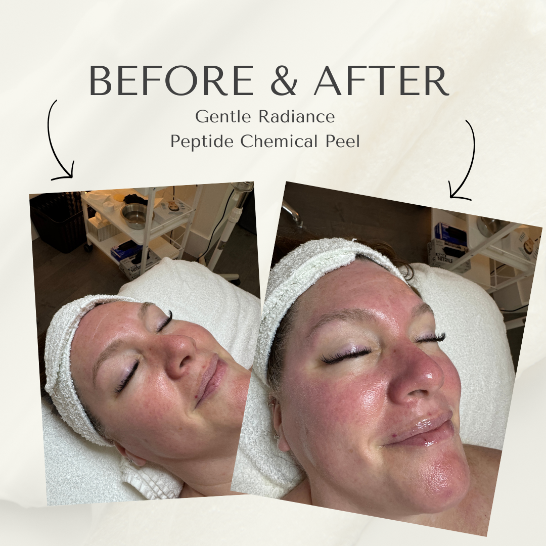 Chem Peel BeforeAfter (1).png