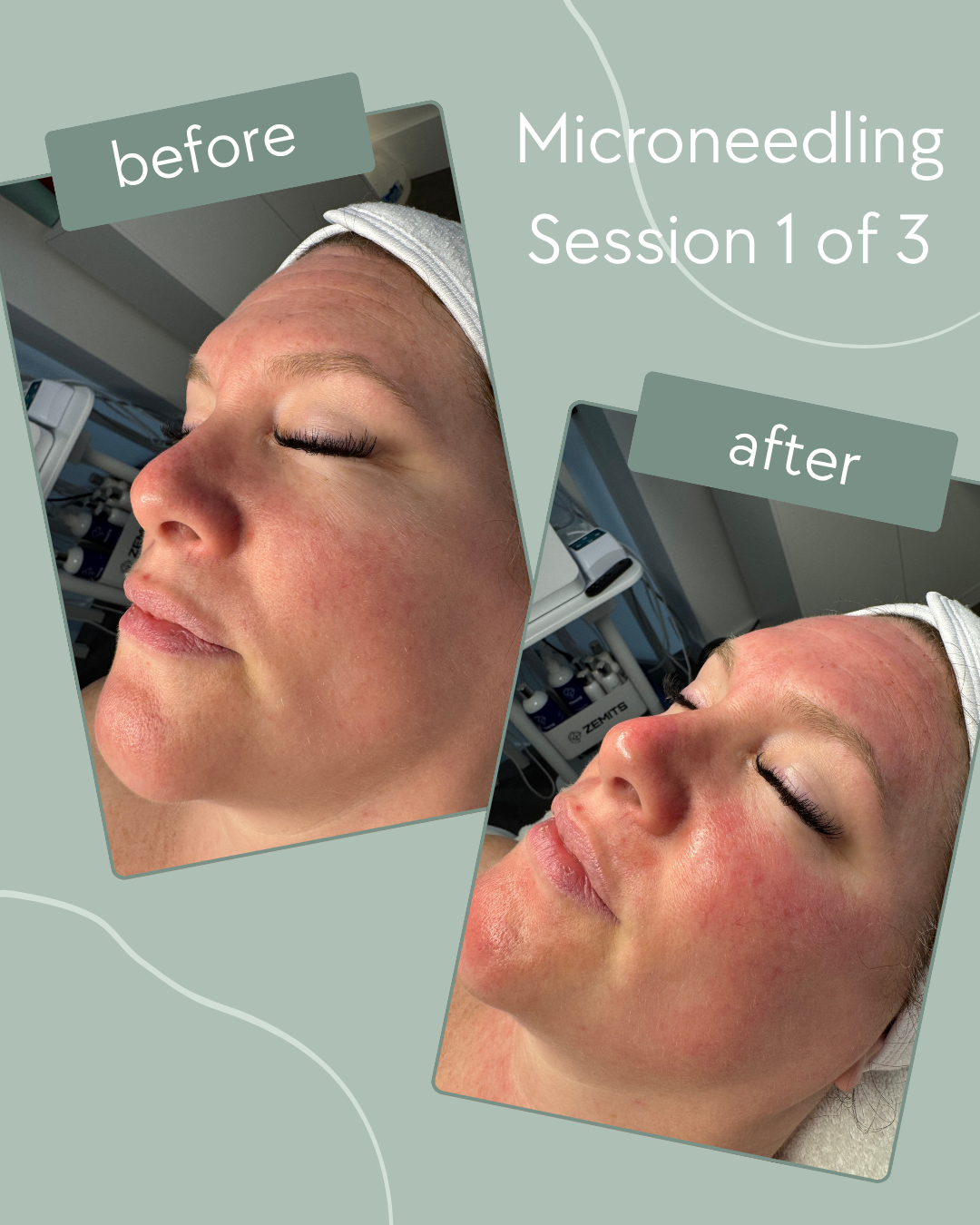 Microneedling before & after.png