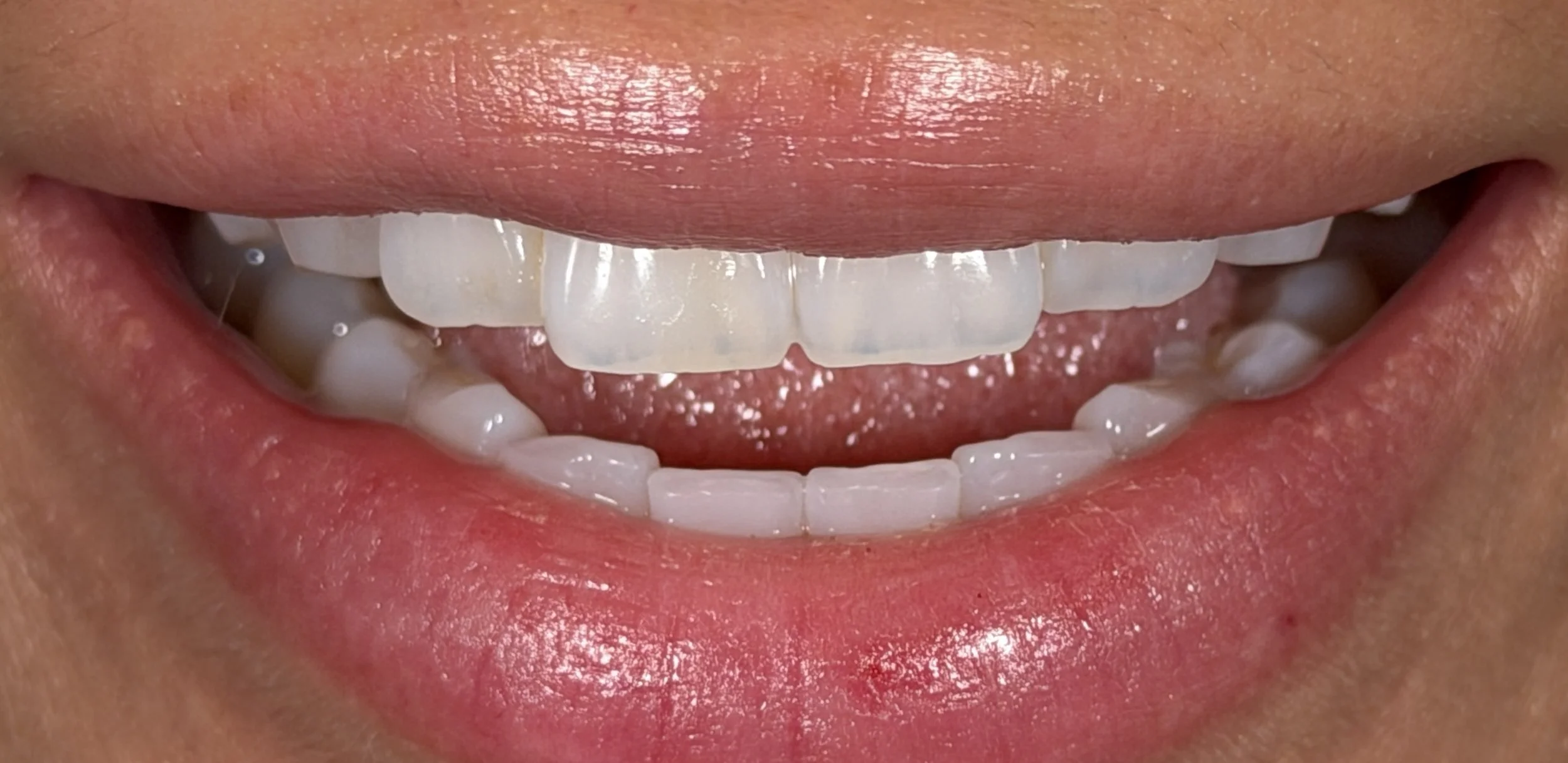 Close-up of a person's smile showing upper and lower teeth with some visible dental veneers.
