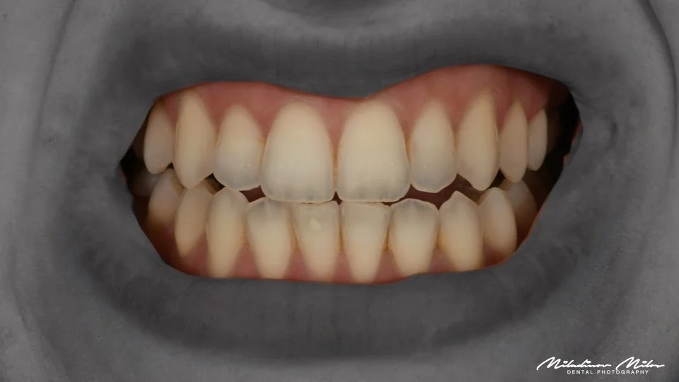 Close-up of a person's teeth and mouth, showing upper and lower teeth with some spacing and slight misalignment. PolariZ  polarisation filter  for  twin flash Godox MF-12 K2 by Milos, ideal for intraoral  dental photography, helps removing glare and