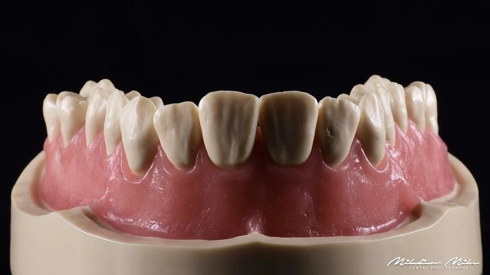 Close-up of a dental model showing upper teeth, with some teeth discolored and worn, and visible gum line against a black background.