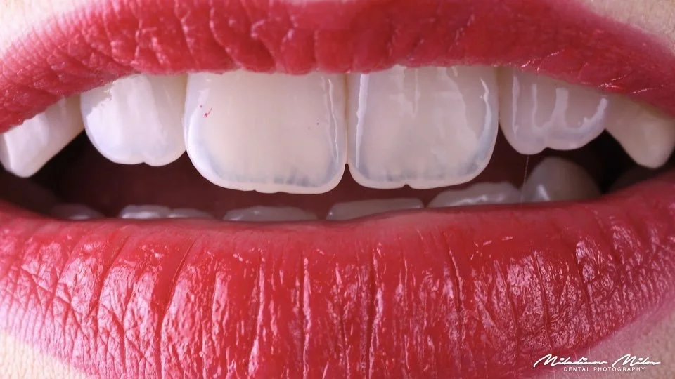 Close-up of a person's open mouth showing white teeth and red lipstick.