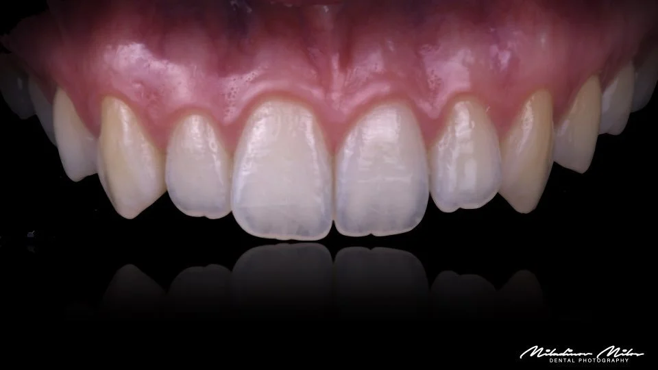 Close-up of an upper row of teeth, showing some chipping and discoloration, with pink gums above.