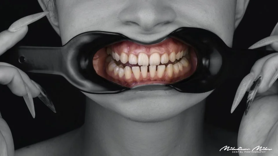 A person holding a dental mirror with both hands, lifting their lips to reveal their teeth and gums.