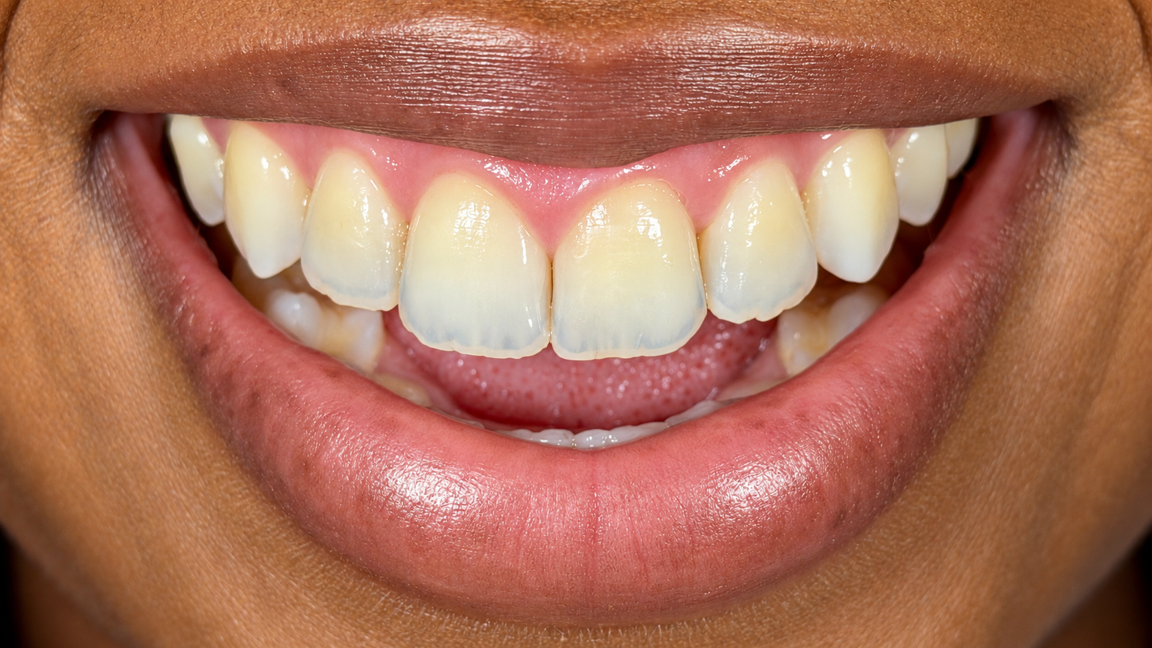 Close-up of a smiling person showing yellowed and slightly crooked upper front teeth.