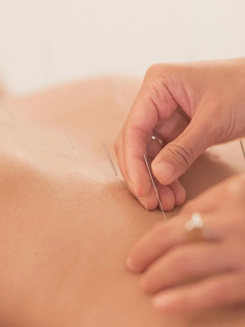 How Acupuncture Supports the Body’s Natural Healing Process