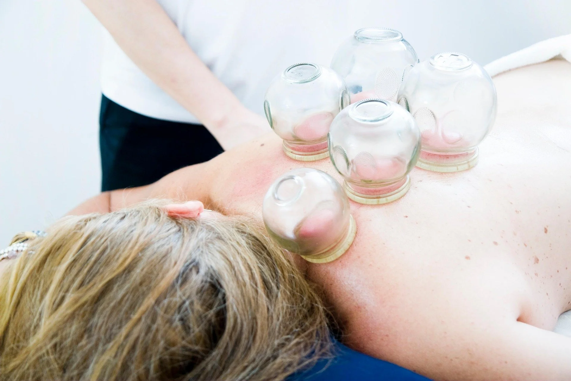 Cupping Therapy: How It Works and What You Can Expect