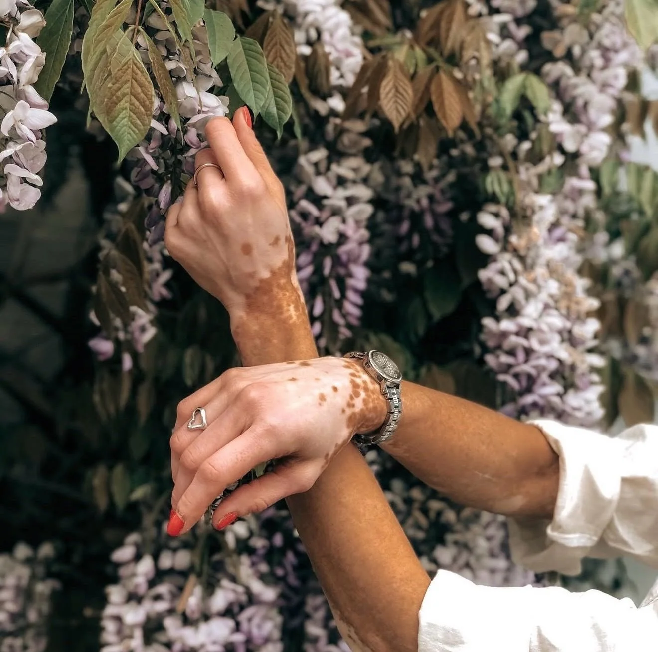 Vitiligo is a visible skin condition.

But the real issue?

How society responds to anyone that looks different.

Awareness isn&rsquo;t just about knowing what vitiligo is. It&rsquo;s about changing how we treat people who have it.

Because differenc