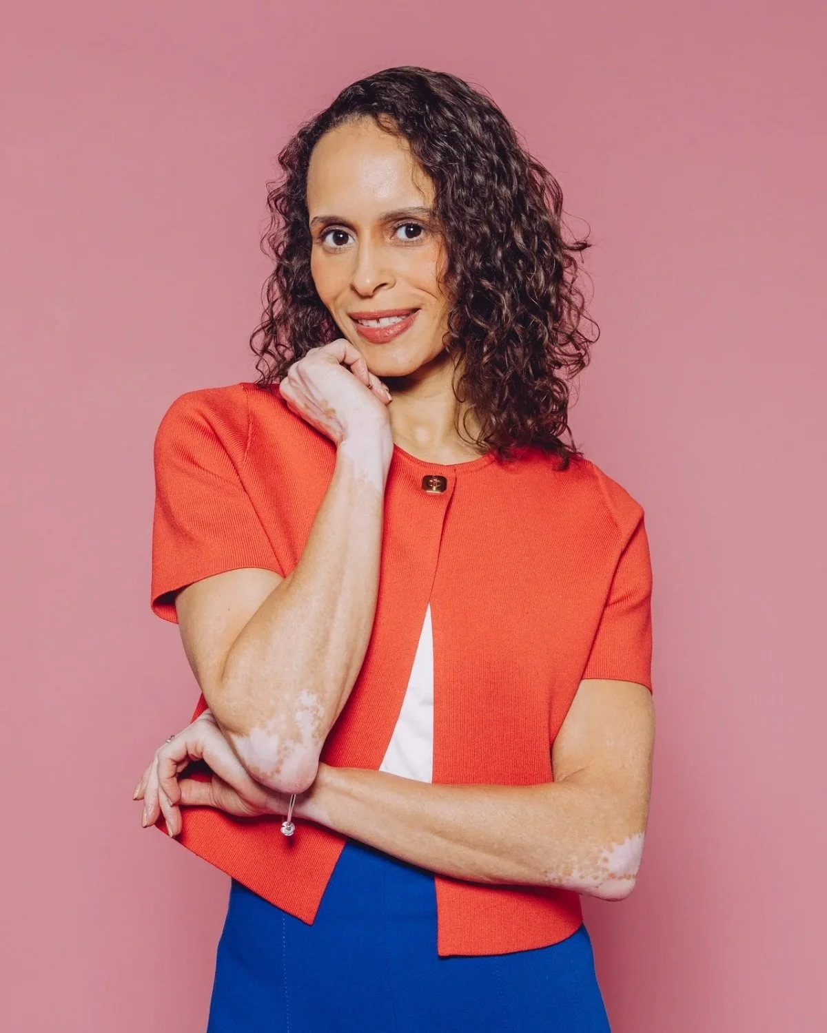 This week is Face Equality Week, and the launch of @changingfacesuk new campaign &lsquo;Think Before You Speak&rsquo;. 

I&rsquo;m reminded every day that I have vitiligo and whilst that can come from my own internal thinking, there are times when ot