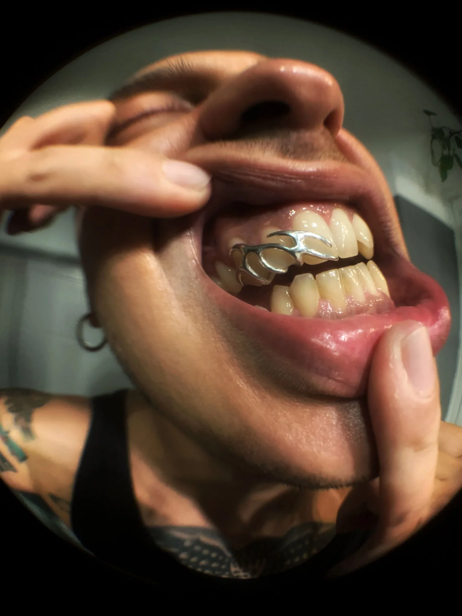 Close-up of a person's face and mouth, showing a metal dental retainer on their upper teeth, with someone touching their lip and chin.