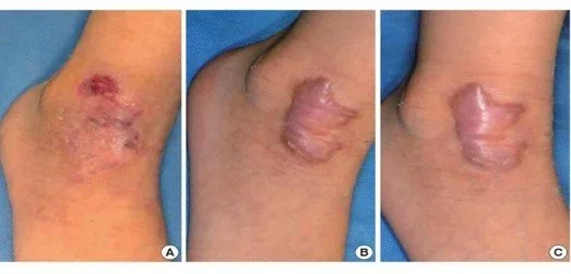 Progression of wound healing on an elbow, showing an open sore, then partially healing, and finally healed skin.