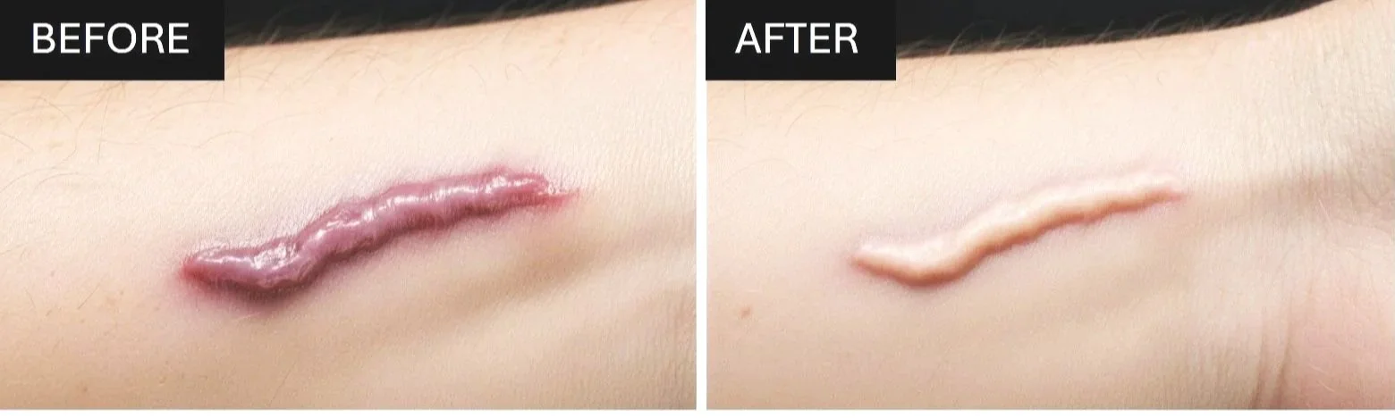 Comparison of a person's skin with a large, textured scar in a before and after treatment. The before image shows a thick, raised scar, while the after image shows a much smoother, less prominent scar.