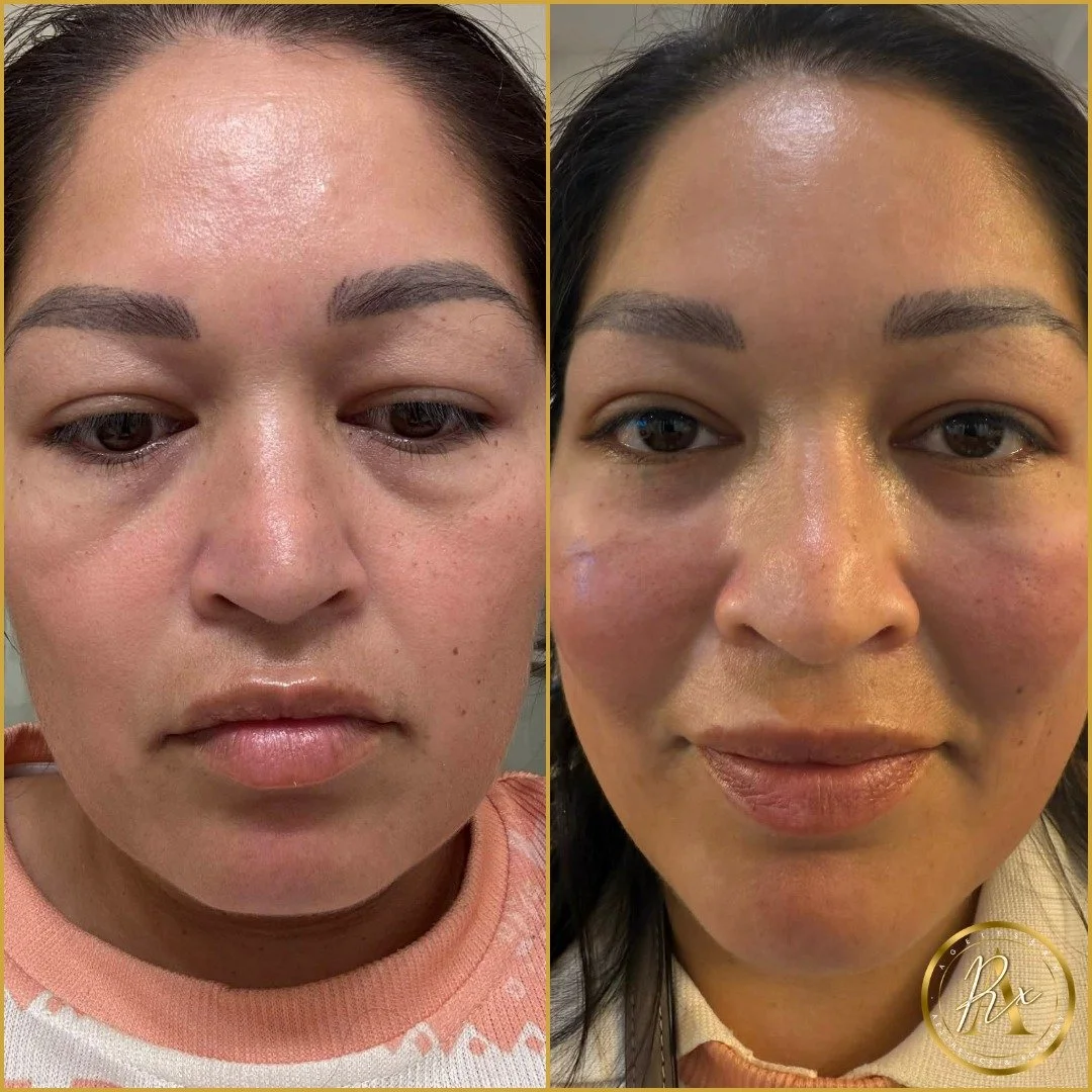 Transform Your Look with Cheek Fillers! 🌟

Are you feeling like your face lacks the youthful fullness you once had? Cheek fillers could be the perfect solution for you! Look at our latest transformation from one of our class models, showcasing the i