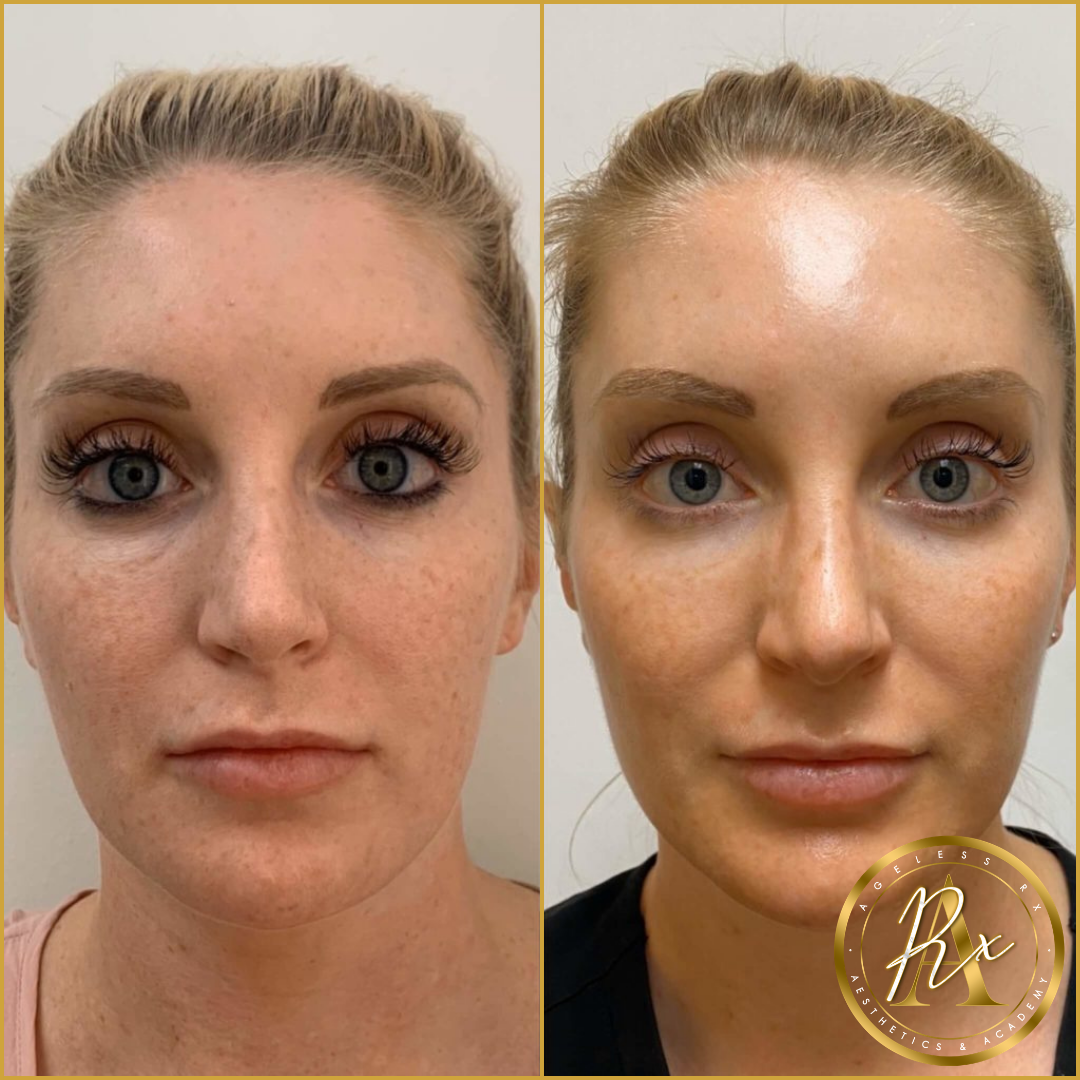 PRP/PRF Mesotherapy