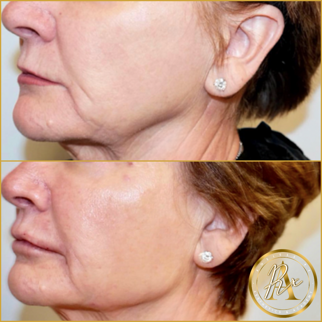 Jawline Filler (Jowl Improvement)