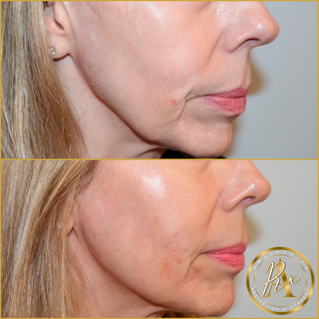 Jawline Filler (Jowl Improvement)