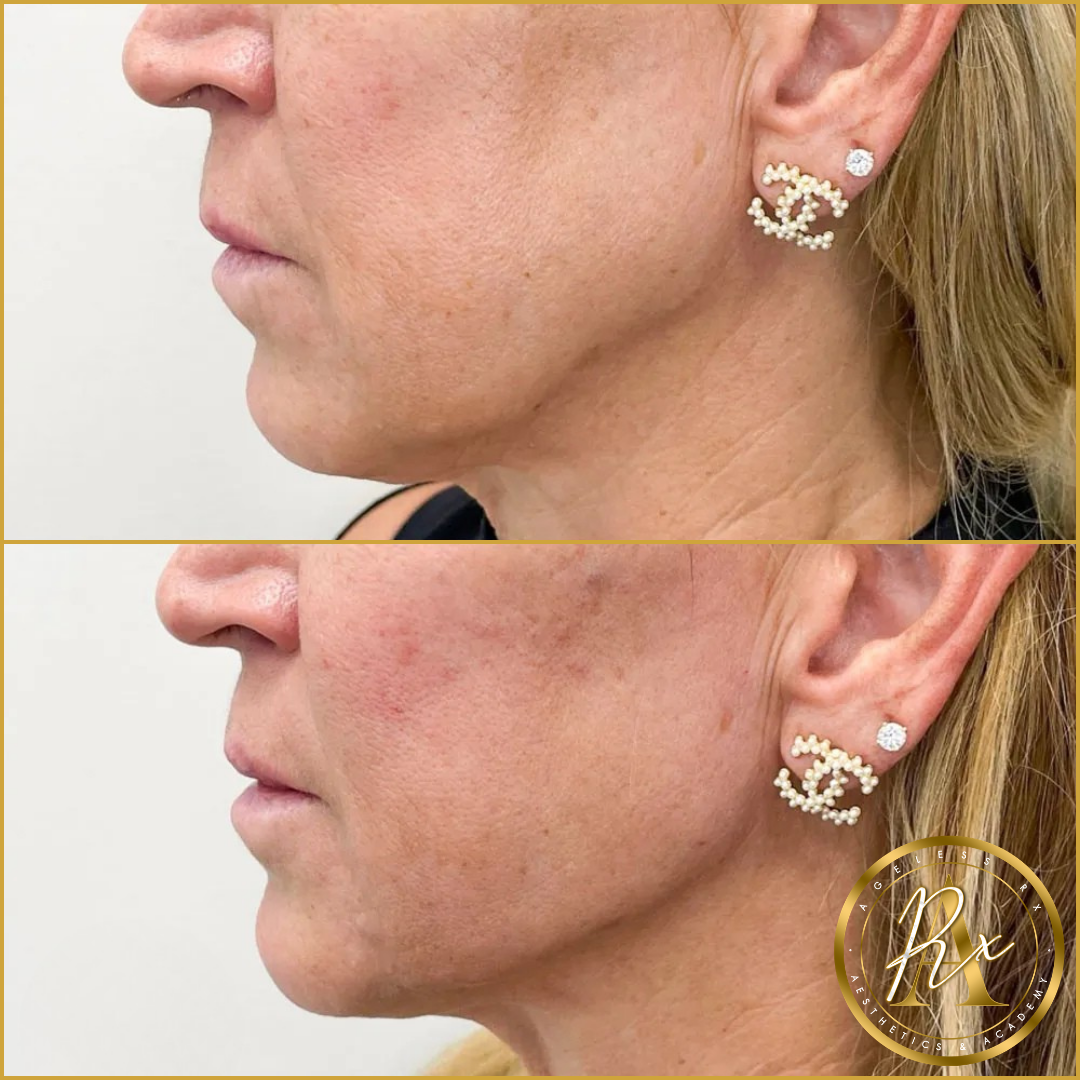 Jawline Filler (Jowl Improvement)