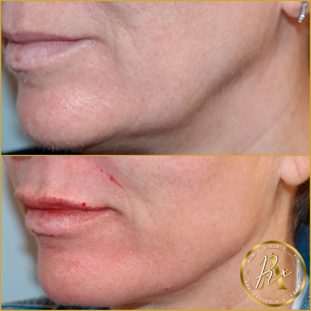 Jawline Filler (Jowl Improvement)