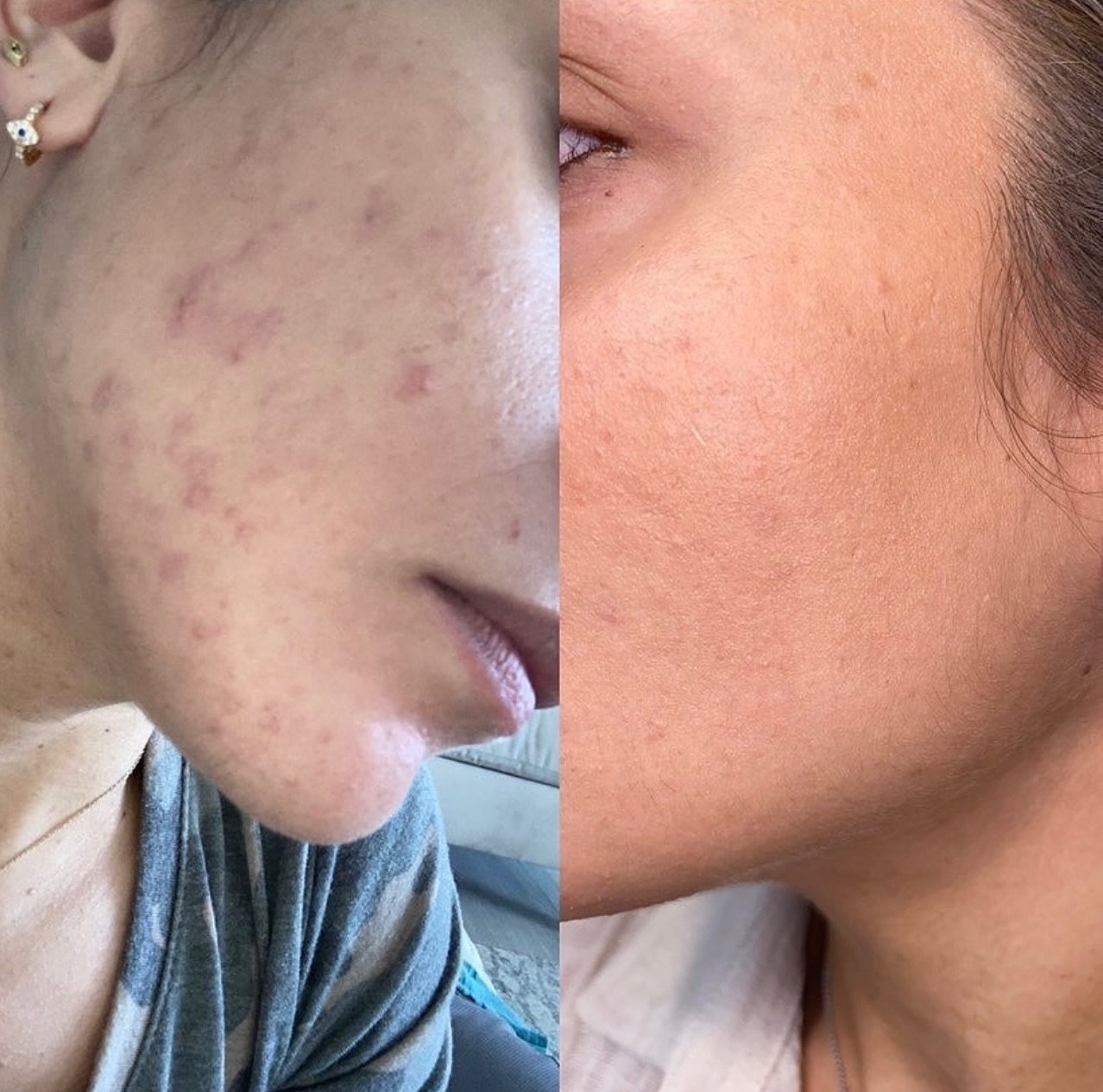 Clear skin is achievable through consistency 🤍 

Have Acne? We&rsquo;ve got you! We tailor all of our treatment plans to get you to your dream skin.