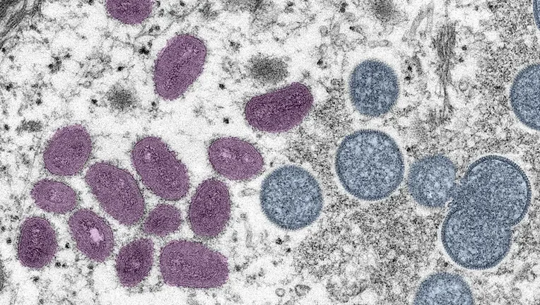 Mpox: Arizona reports case involving a new type of the virus 🤔