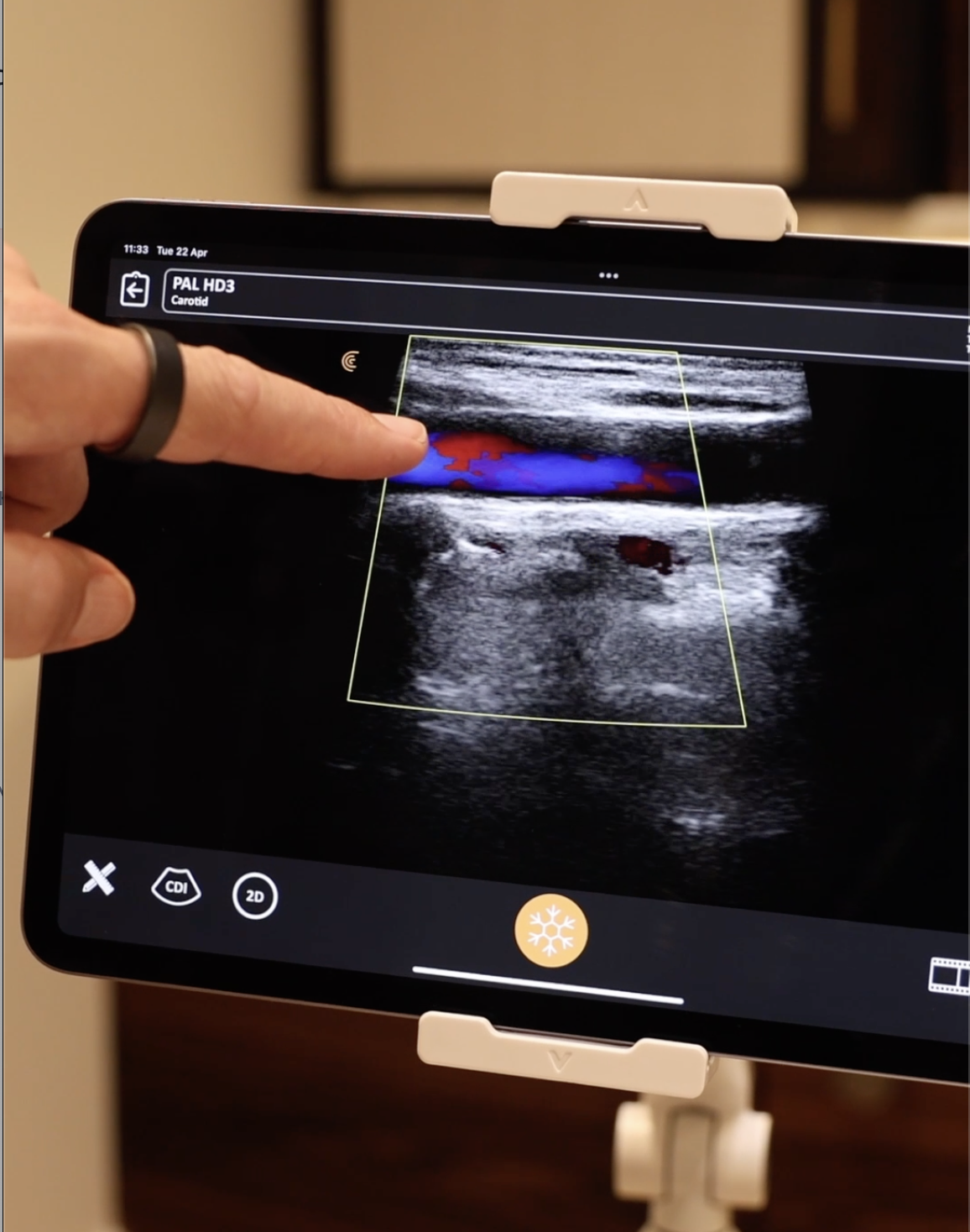 Carotid Artery Ultrasound (Stroke Risk Assessment)