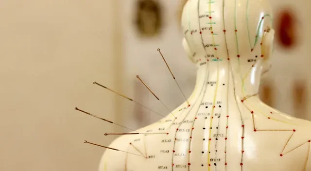 An acupuncture model of a human neck and shoulders with numerous acupuncture needles inserted into specific points.