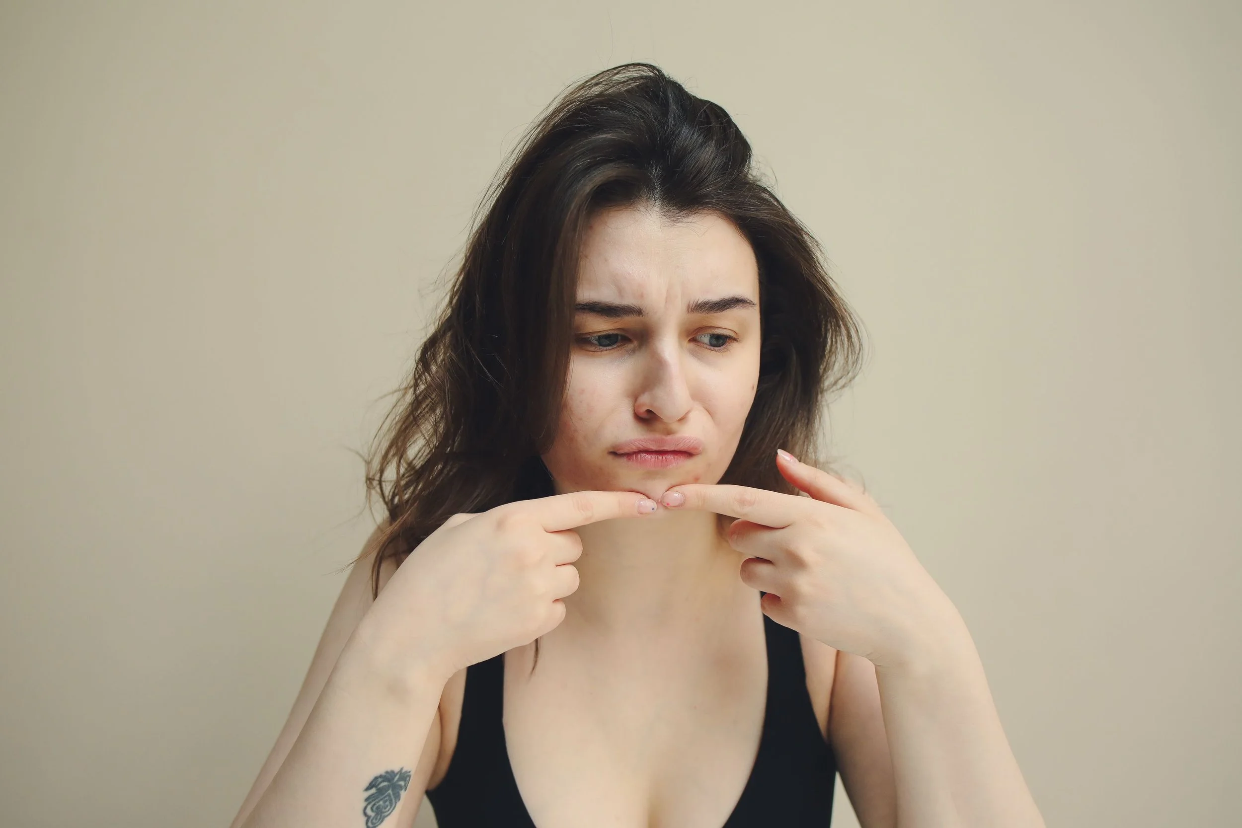 Young woman examining hormonal acne on her chin, a common symptom of PMOS caused by excess androgens