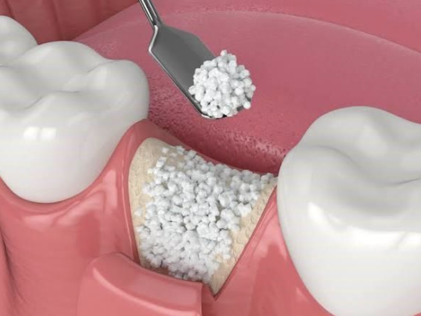 Close-up of a dental procedure showing a dental filling being placed into a cavity between two teeth, with a dental instrument holding filling material over the cavity.