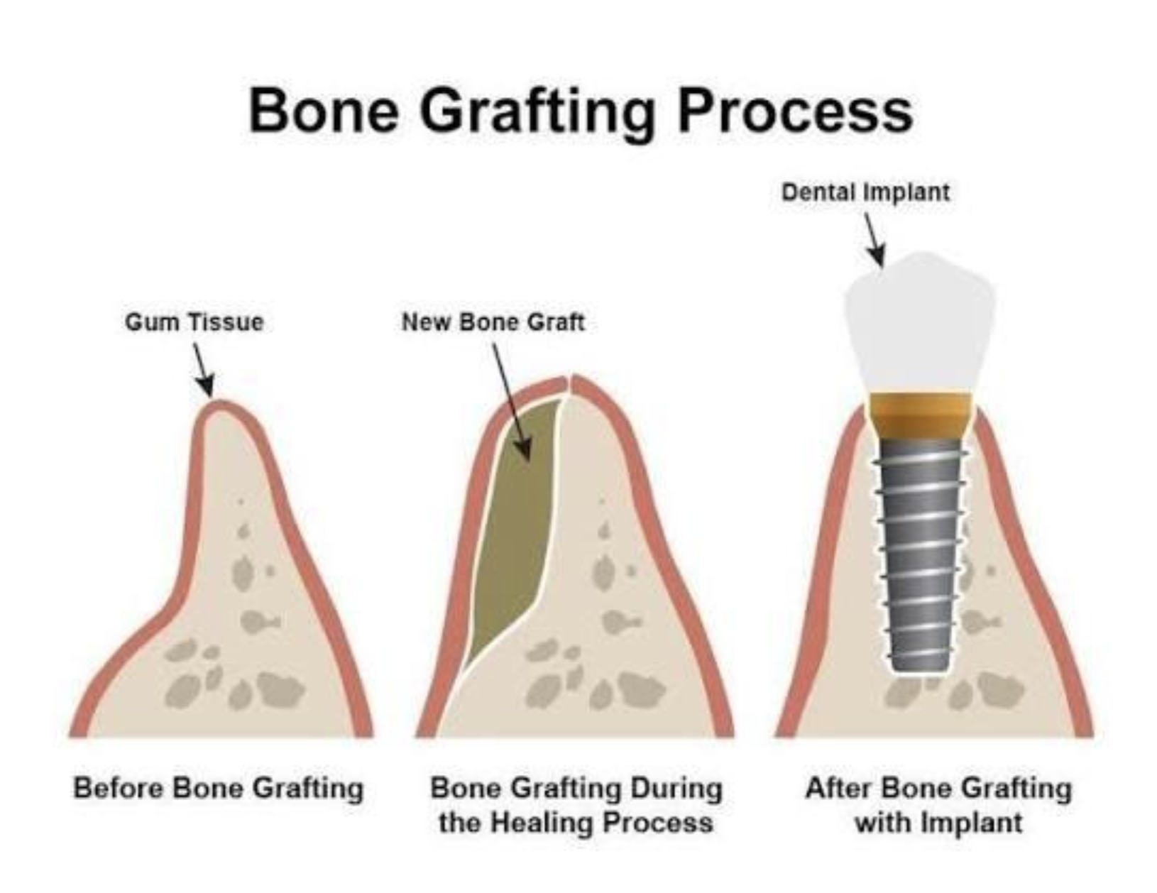Diagram showing the bone grafting process, including before bone grafting with gum tissue, during healing with new bone graft, and after implant placement with dental implant.