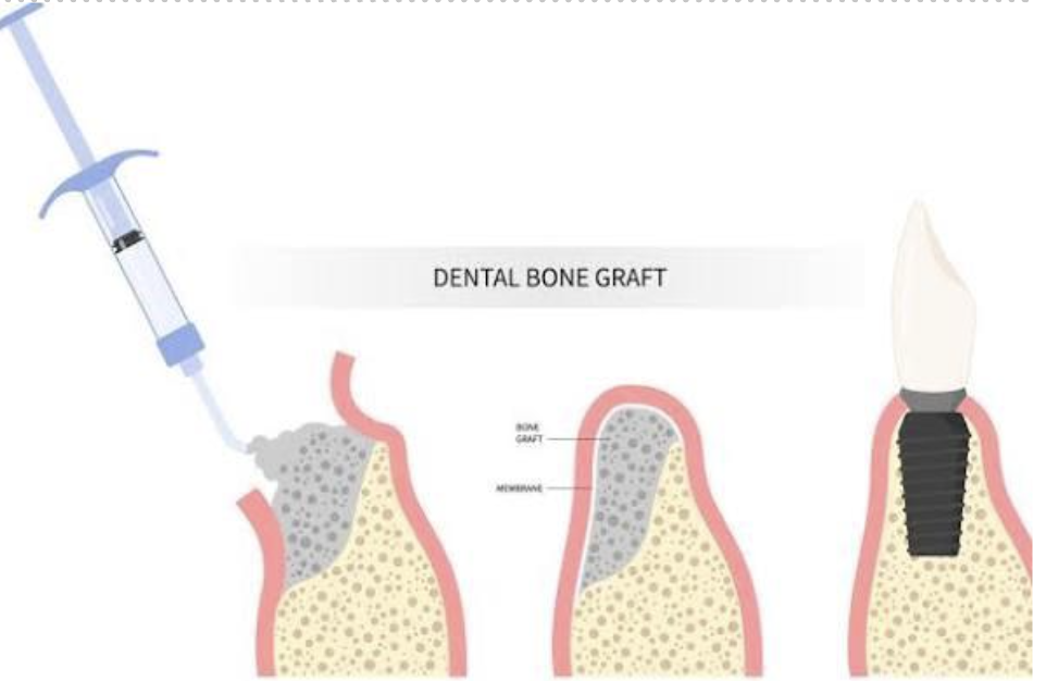 Diagram showing the process of a dental bone graft, including extraction of bone, placement of bone graft material, and dental implant insertion.
