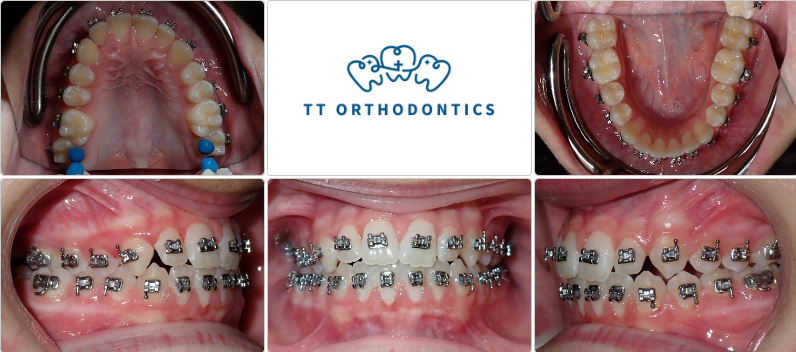 We are excited to see the changes so far, with the front teeth crossbite and cant corrected!