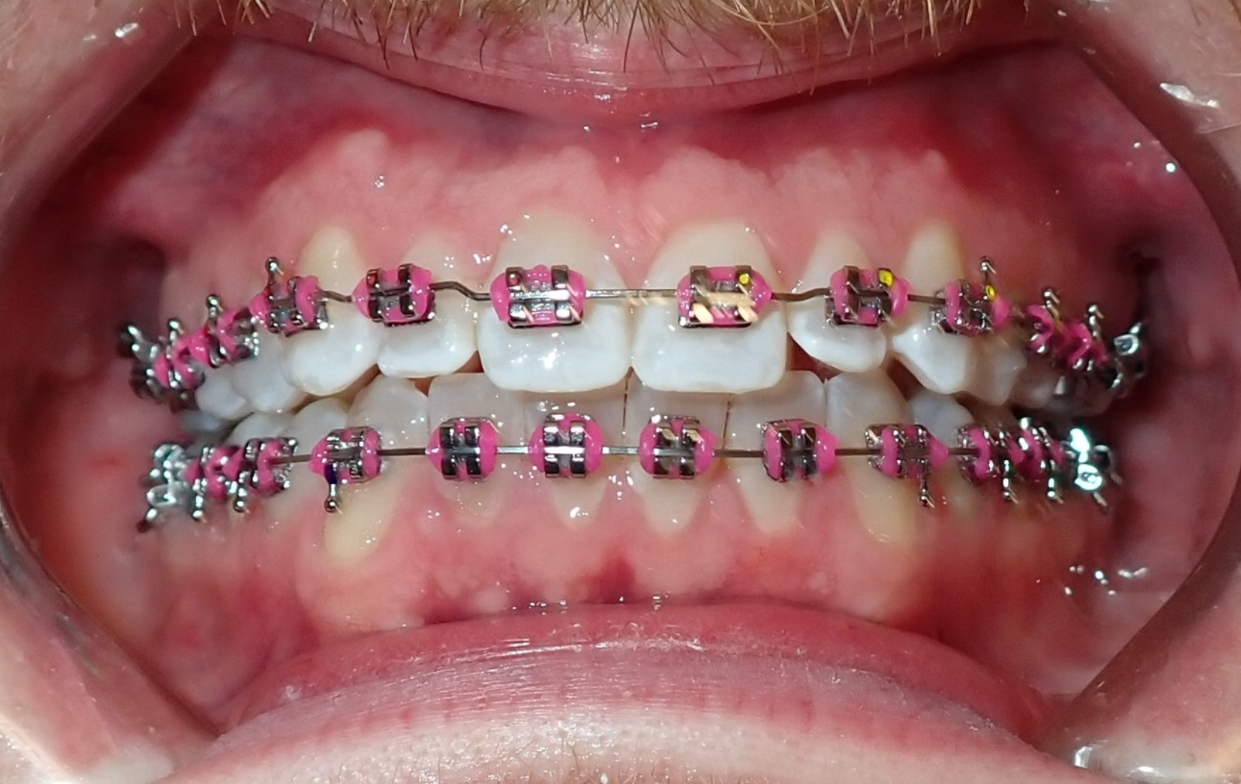 Close-up of a person's mouth showing braces on the upper and lower teeth, with some braces having pink bands.