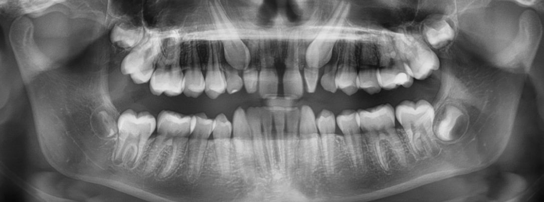 This 12 years old boy came with the top i-teeth heading towards the front teeth. This is called "impacted maxillary canines." The poor direction of the impacted top i-teeth can damage the front teeth roots.