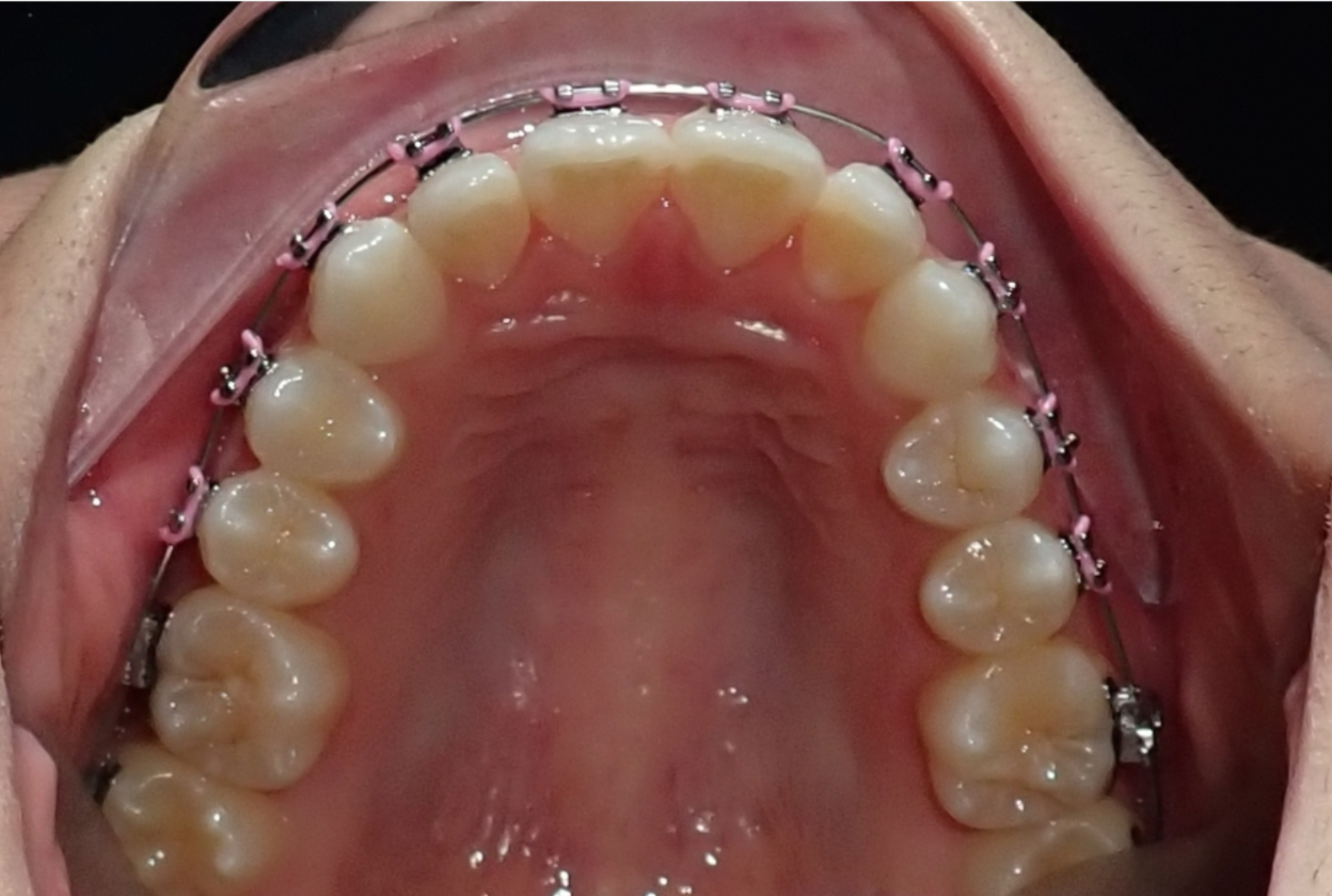 Inside of a person's mouth showing upper teeth with orthodontic braces with metal wires and pink elastic ties.