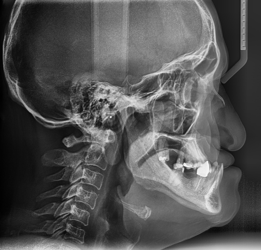 X-ray of a human skull showing a fracture in the jaw and dental issues.