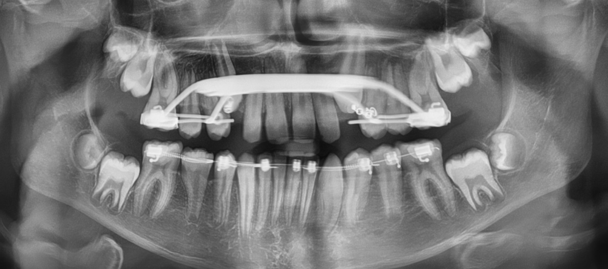 We are happy to show that both the impacted top i-teeth have been pulled away from the roots of the front teeth, and are now on their improved pathway to erupt into the mouth!