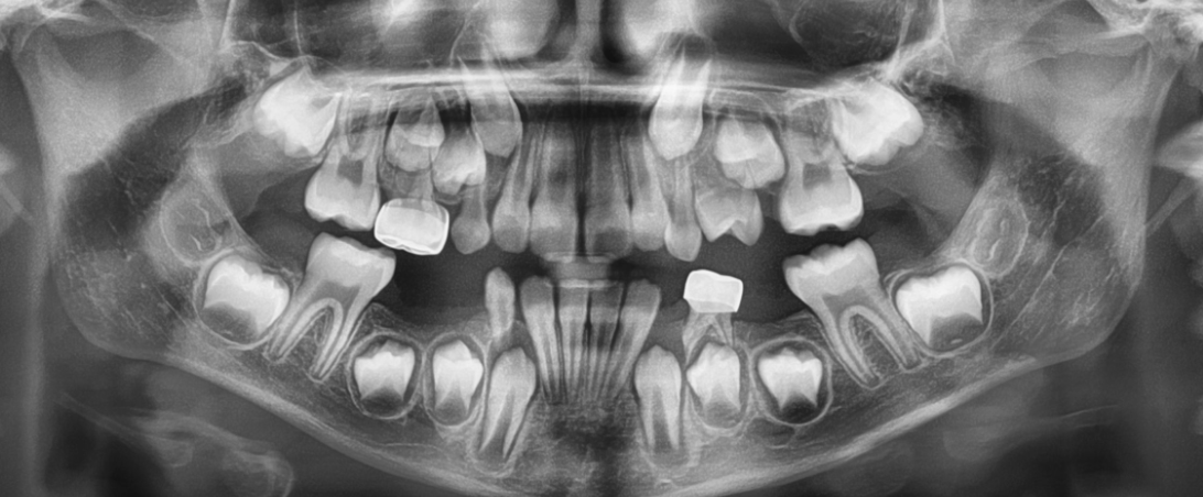 This 9 years old girl came in with early loss of various baby teeth, including the one right in front of the top left adult molar. The adult molar had drifted into the premolar space, causing "loss of space" in the area.