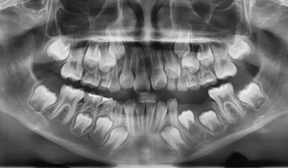 X-ray image of a child's teeth showing both primary and developing permanent teeth.