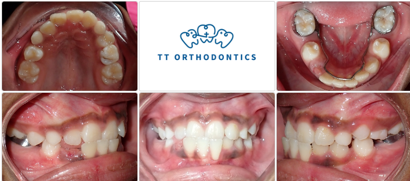 This 10 year old boy came with top front teeth sitting behind the bottom front teeth and pushing the bottom teeth, causing the gums to be lost.
