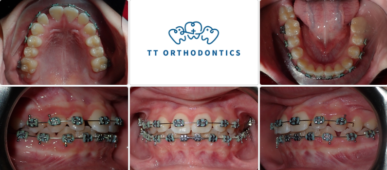 We are happy to see that now, his top front teeth are sitting properly in front of his bottom front teeth!