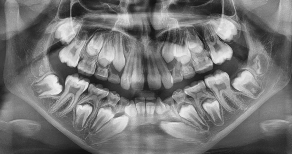 This 10 year old boy came with both bottom i-teeth heading towards the bottom front teeth. This situation is called "impacted mandibular canines." The poor direction of the i-teeth can damage the front teeth.