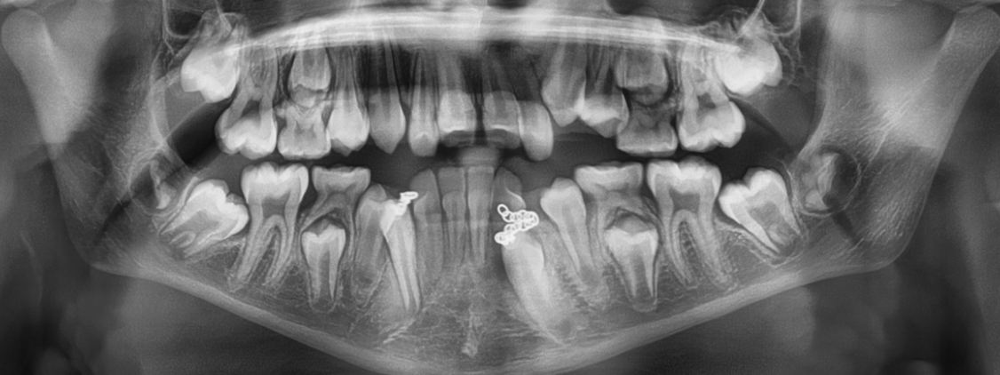 After working with a surgeon, those two impacted bottom -teeth are in good progress of getting straighter, and getting pulled away from the bottom front teeth. We are excited to witness such positive results!