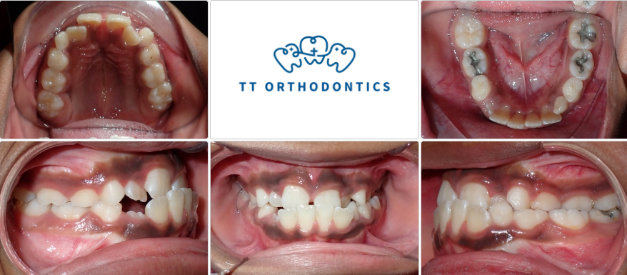 This 9 years old girl came in because of her top teeth sitting behind the bottom front teeth.