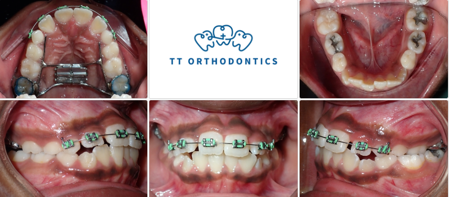 We are happy with the progress so far, as her top front teeth are now sitting properly in front of the bottom front teeth!