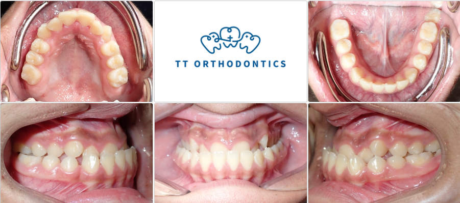 This 12 years old girl came in with crossbite in all teeth in her mouth. The top front teeth were behind the bottom front teeth, and the top back teeth were sitting inside the bottom back teeth.